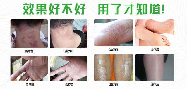 樱桃视频APP免费下载真菌清噴劑